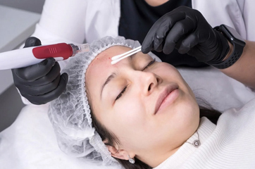 microneedling facial