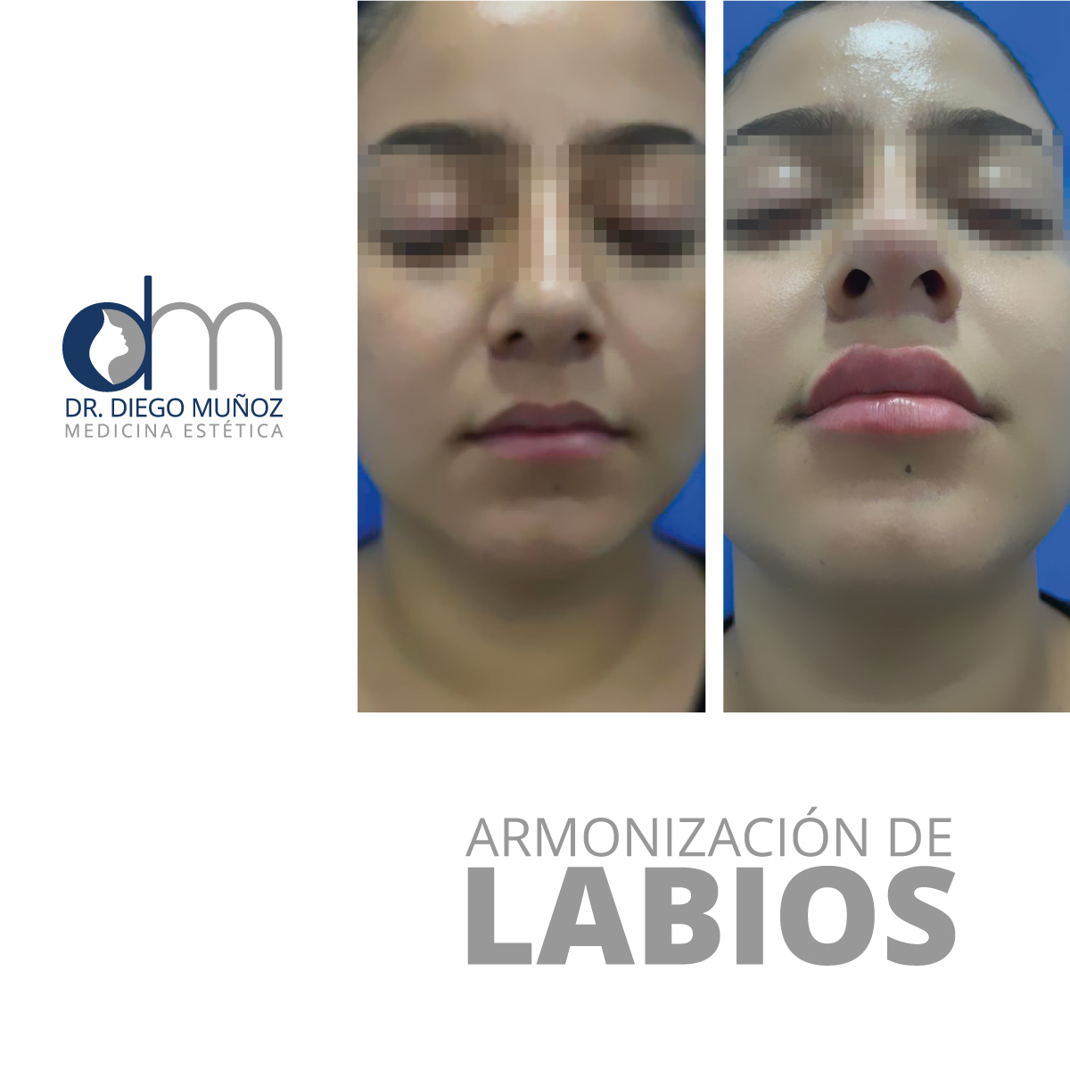 armonización de labios