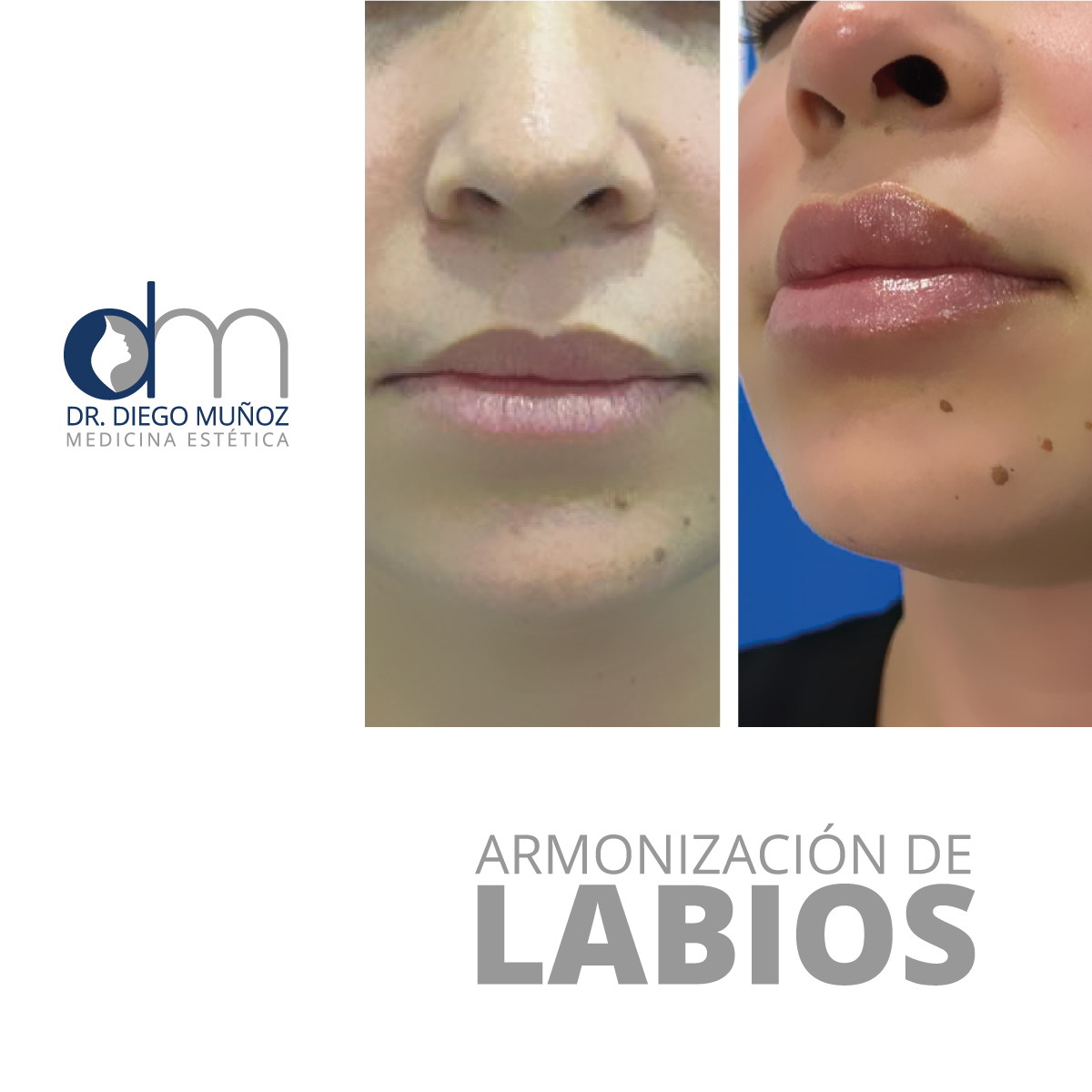 armonización de labios