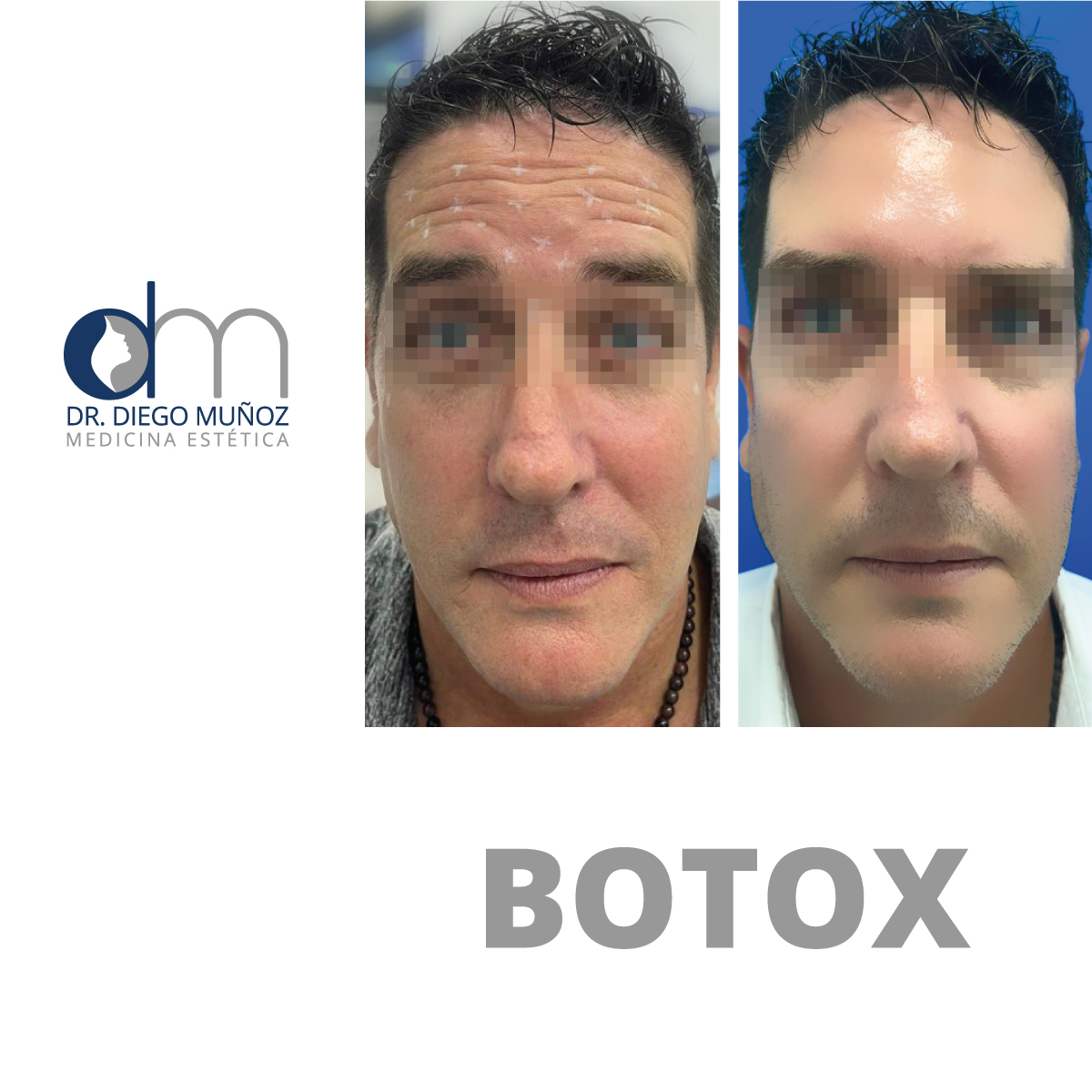 botox