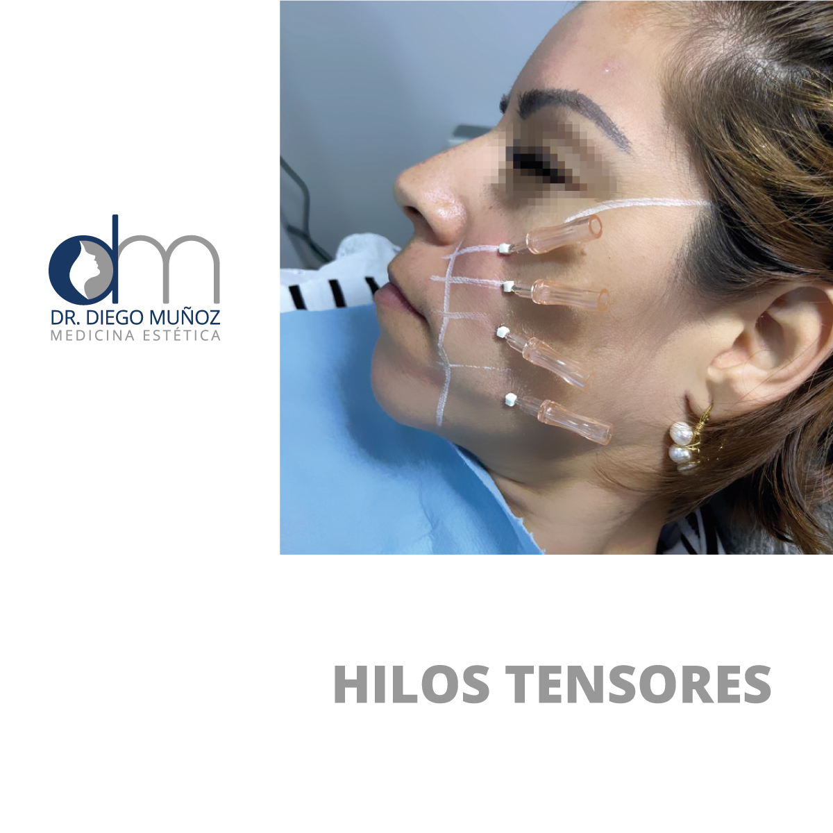 hilos tensores